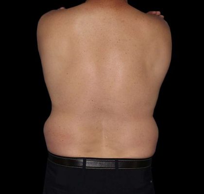 Liposuction Before & After Patient #1270