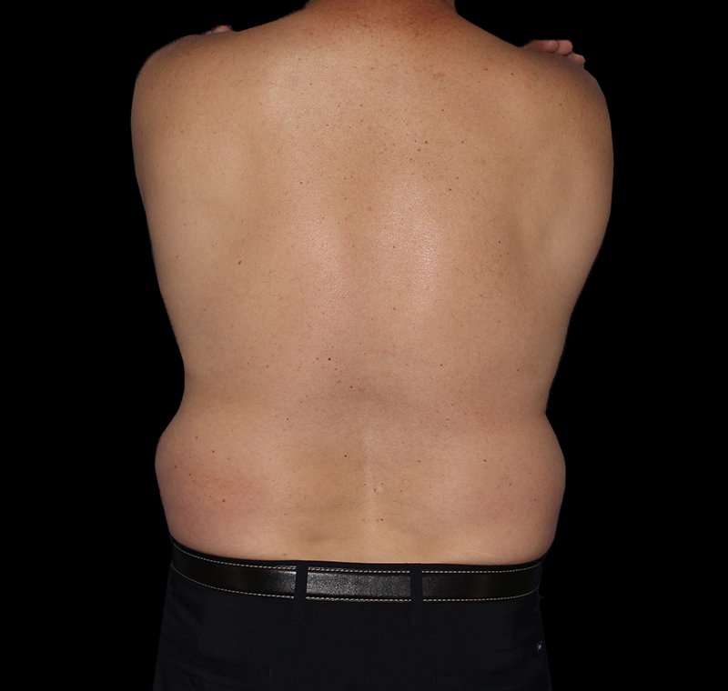 Liposuction Before & After Patient #1270