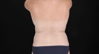 Abdominoplasty (Tummy Tuck) Before & After Patient #693