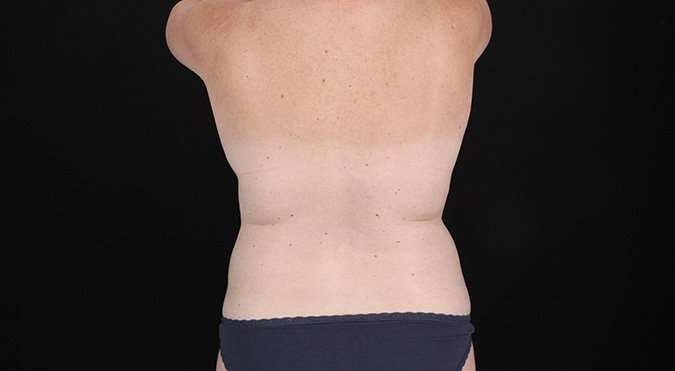 Abdominoplasty (Tummy Tuck) Before & After Patient #693