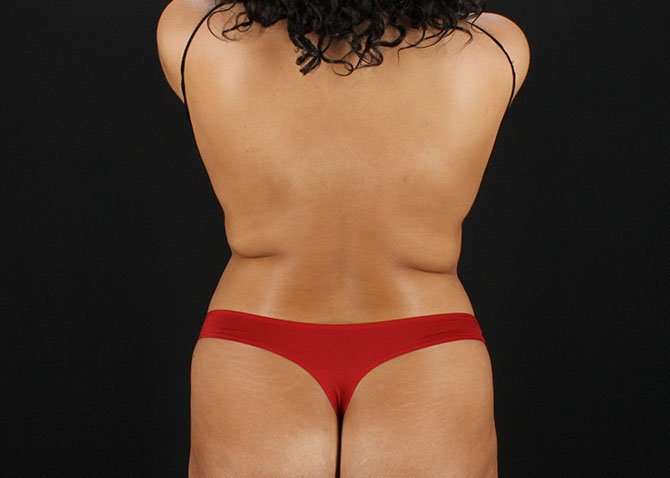 Liposuction Before & After Patient #1469