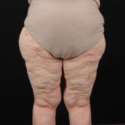 Liposuction Before & After Patient #1495