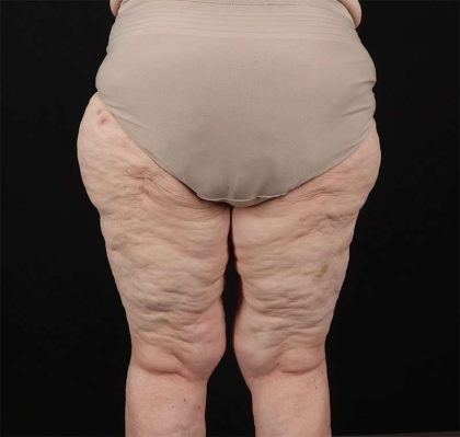 Liposuction Before & After Patient #1495