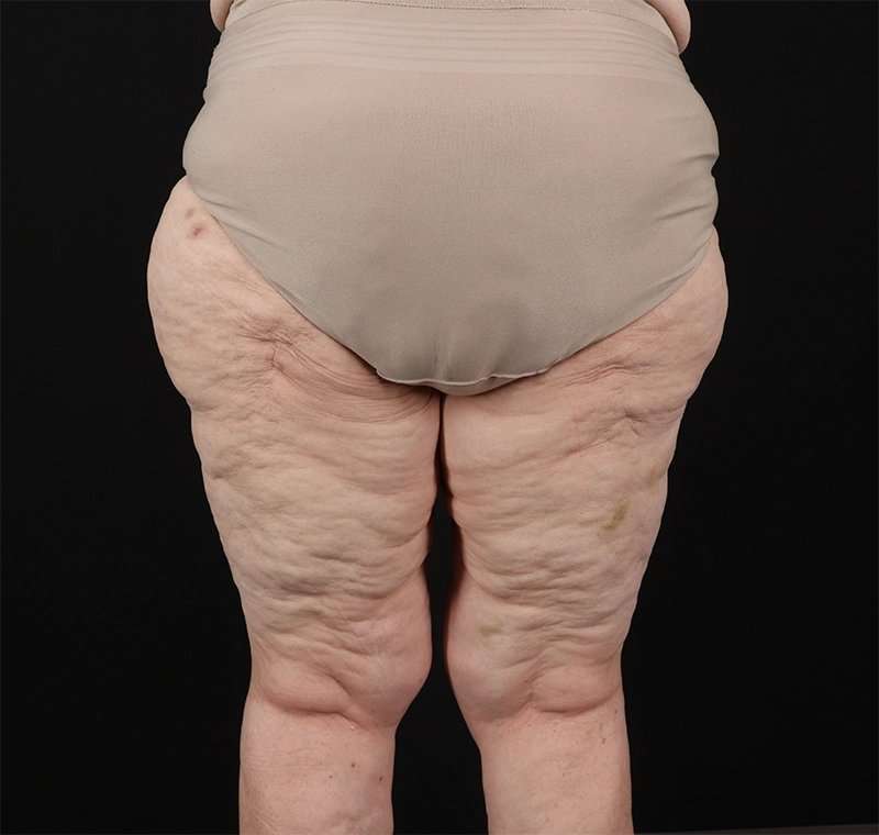 Liposuction Before & After Patient #1495