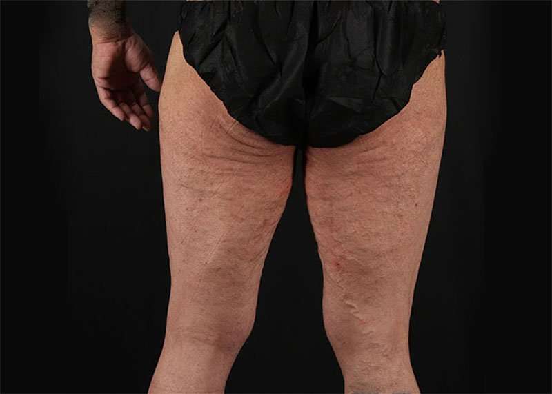 Thigh Lift Before & After Patient #1776