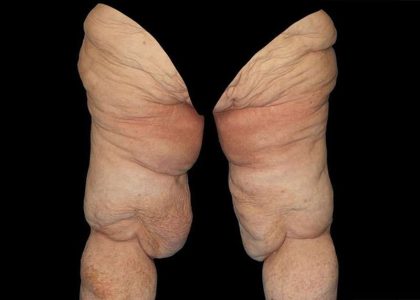 Thigh Lift Before & After Patient #1790