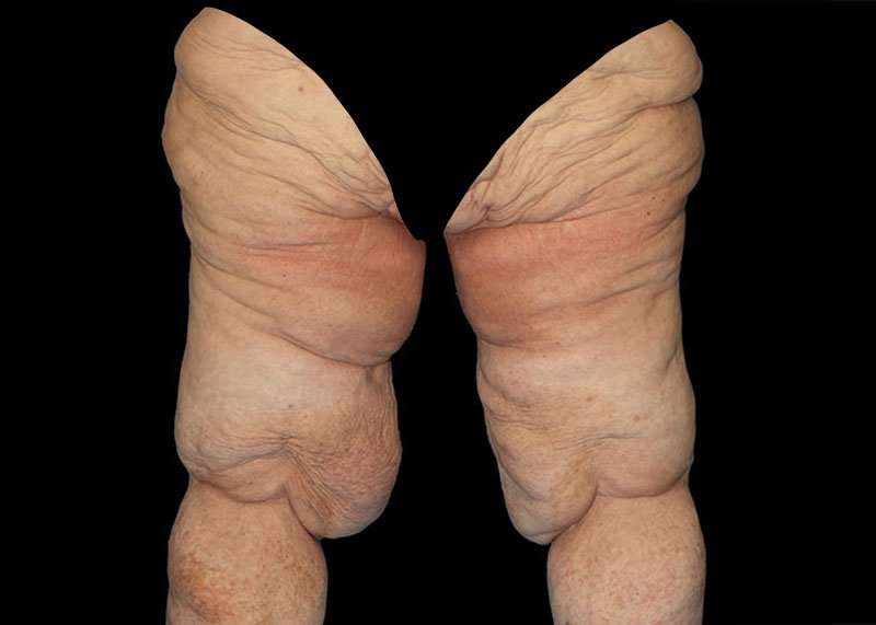 Thigh Lift Before & After Patient #1790