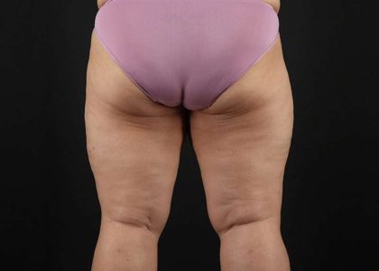 Thigh Lift Before & After Patient #1804