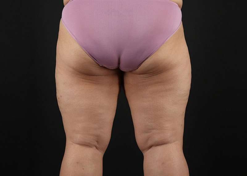 Thigh Lift Before & After Patient #1804