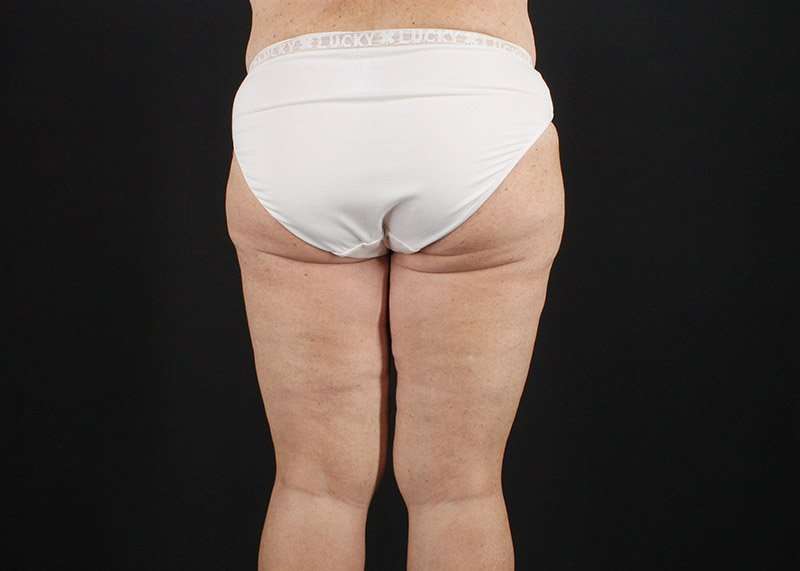 Thigh Lift Before & After Patient #1818