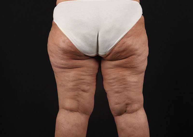 Thigh Lift Before & After Patient #1831
