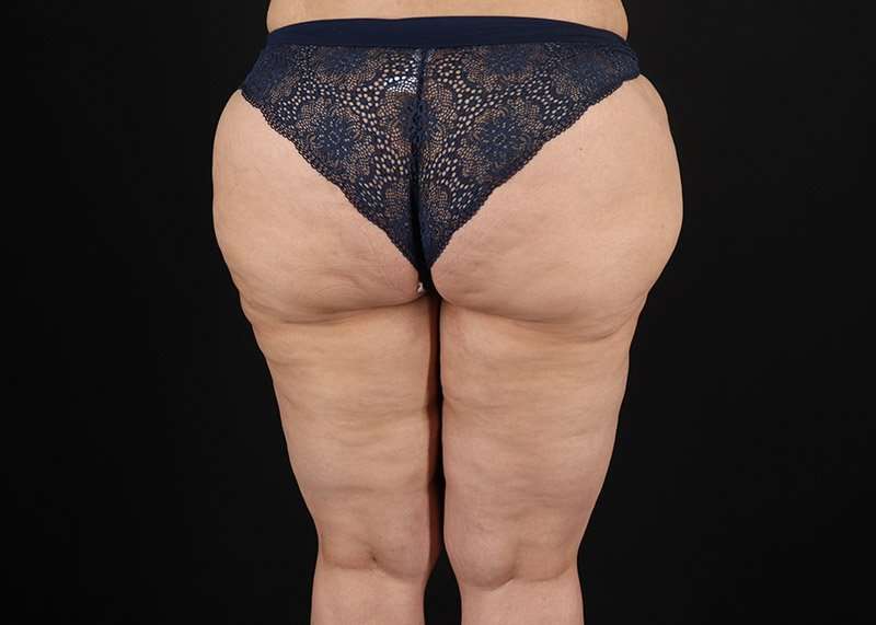 Thigh Lift Before & After Patient #1844