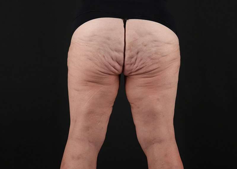 Thigh Lift Before & After Patient #1857