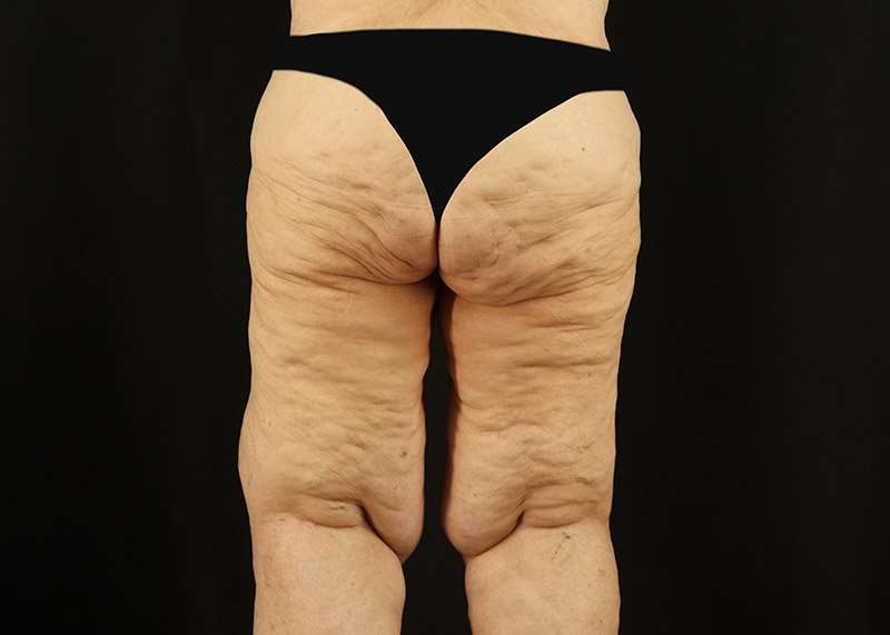 Thigh Lift Before & After Patient #1871