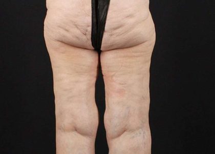 Thigh Lift Before & After Patient #1884
