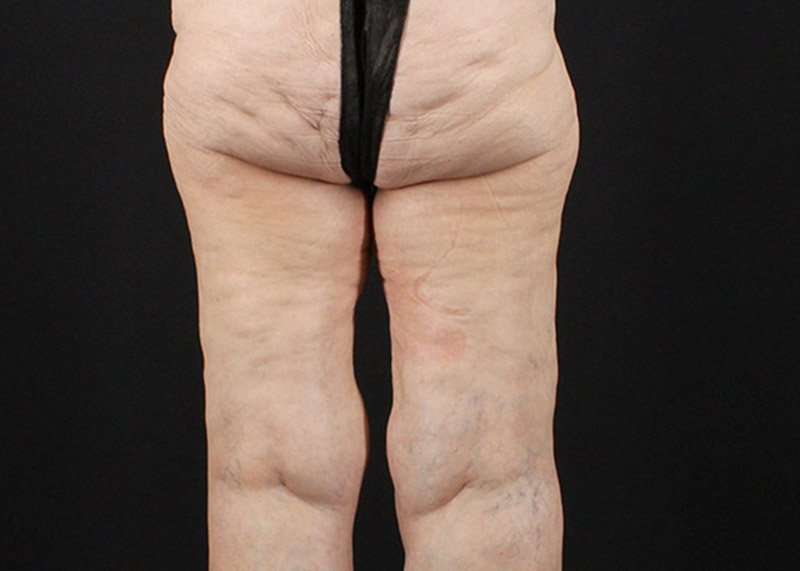 Thigh Lift Before & After Patient #1884