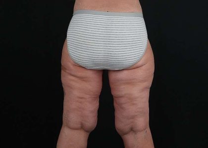 Thigh Lift Before & After Patient #1897