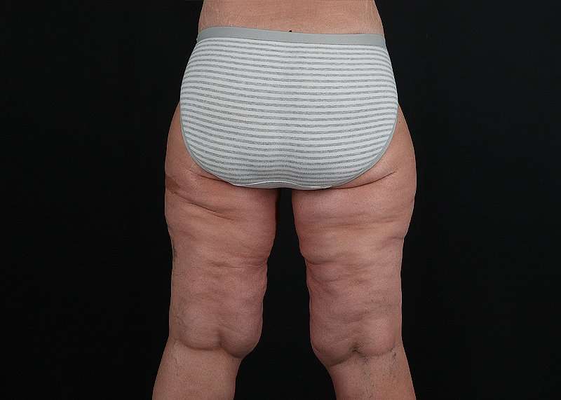 Thigh Lift Before & After Patient #1897