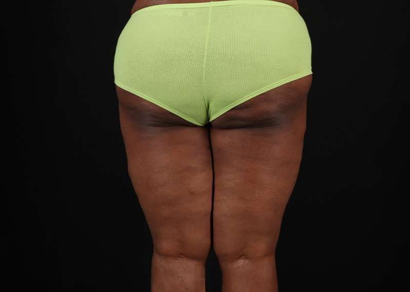 Thigh Lift Before & After Patient #1911