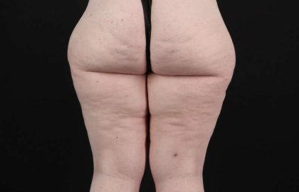 Thigh Lift Before & After Patient #1925