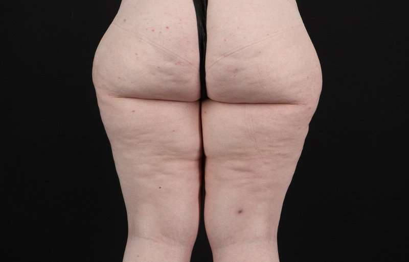 Thigh Lift Before & After Patient #1925