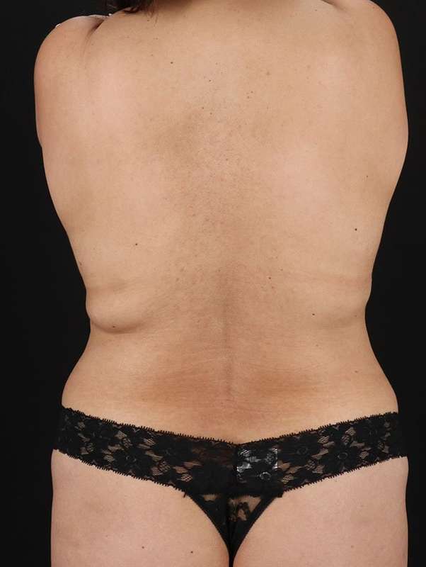 DIEP Flap Before & After Patient #3123