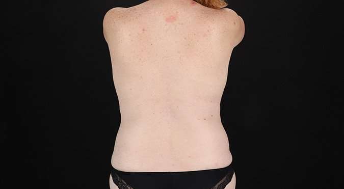 Mastopexy Before & After Patient #3178