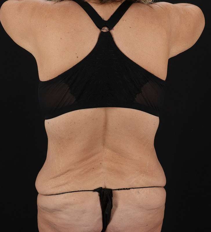 Abdominoplasty (Tummy Tuck) Before & After Patient #817