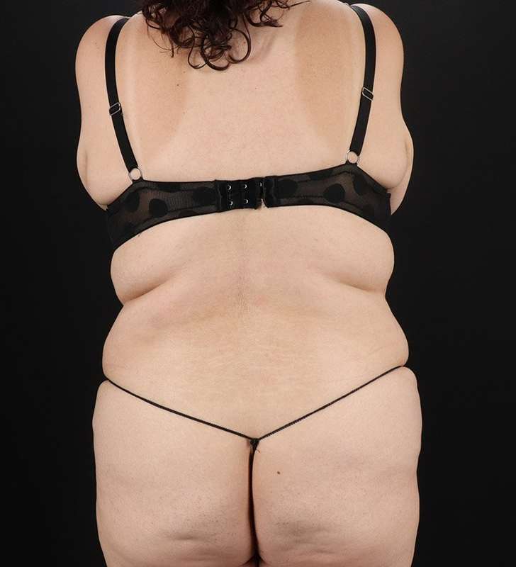 Abdominoplasty (Tummy Tuck) Before & After Patient #830