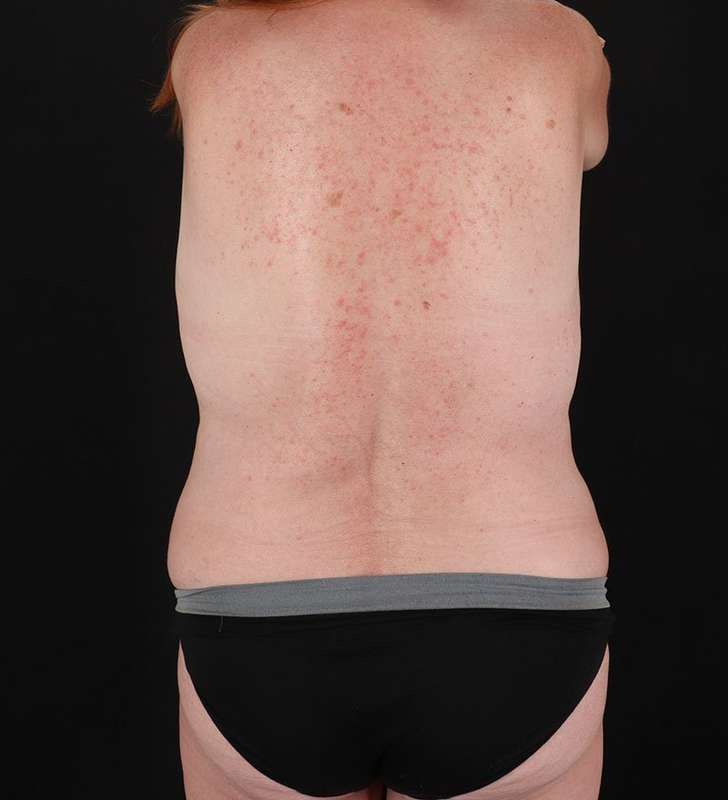 Abdominoplasty (Tummy Tuck) Before & After Patient #962