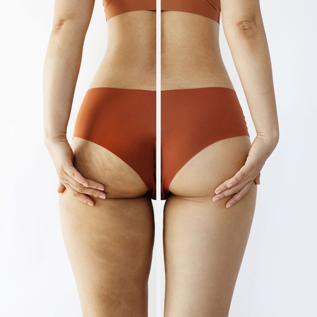 Av&eacute;li Cellulite Treatment