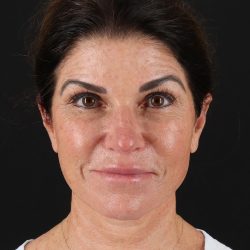 Facelift Before & After Patient #8949