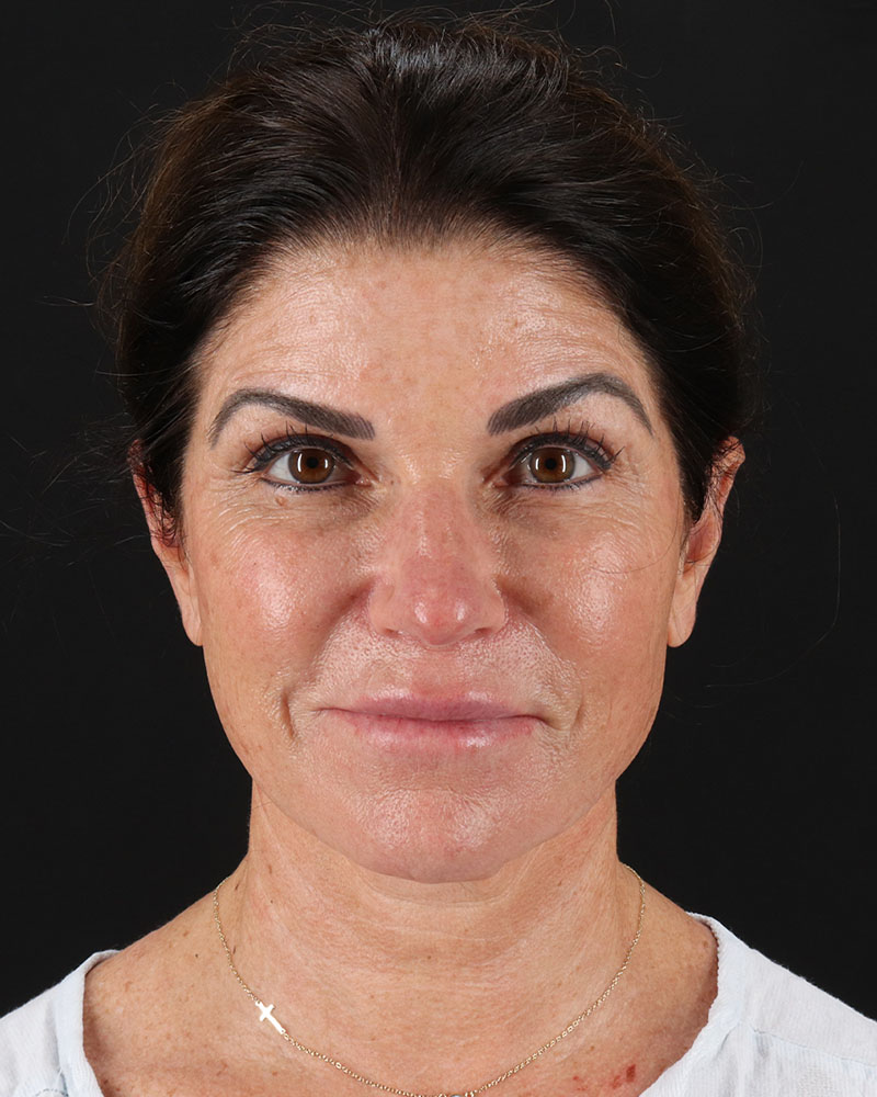 Facelift Before & After Patient #8949