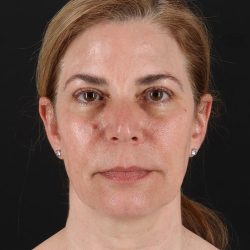 Lower Blepharoplasty Before & After Patient #8951