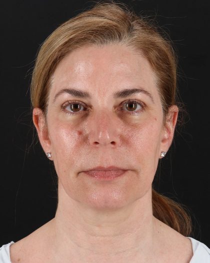Lower Blepharoplasty Before & After Patient #8951