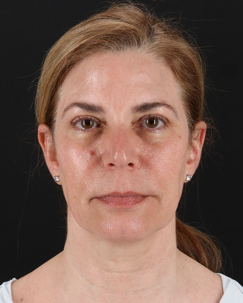 Lower Blepharoplasty Before & After Patient #8951