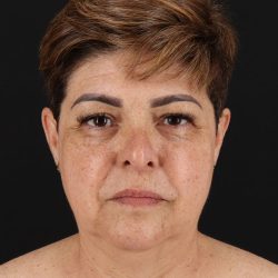 Facelift Before & After Patient #8952