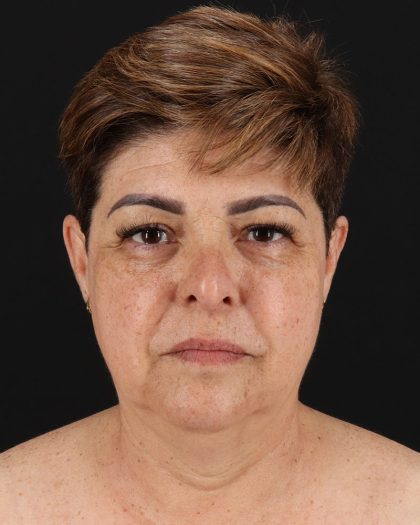Facelift Before & After Patient #8952