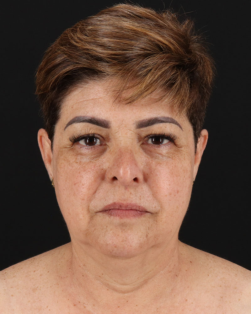 Facelift Before & After Patient #8952