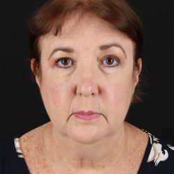 Facelift Before & After Patient #8953