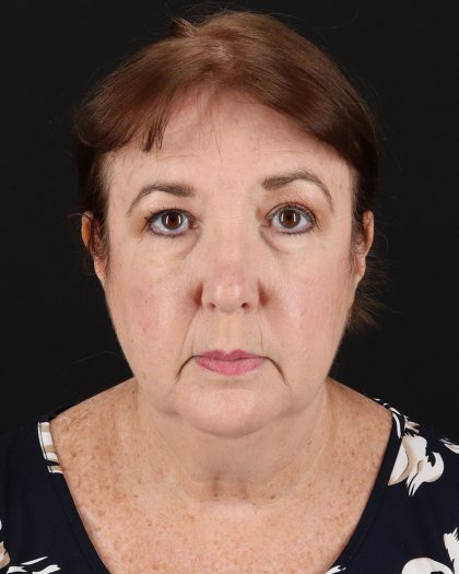 Facelift Before & After Patient #8953