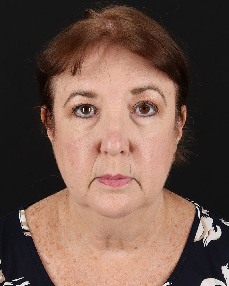 Facelift Before & After Patient #8953