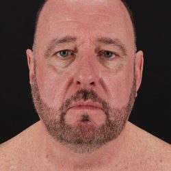 Facelift Before & After Patient #8955