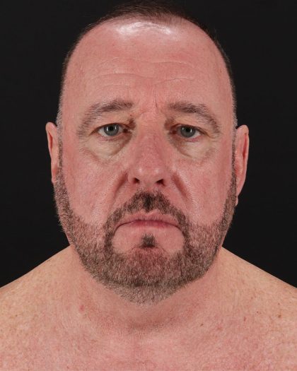 Facelift Before & After Patient #8955