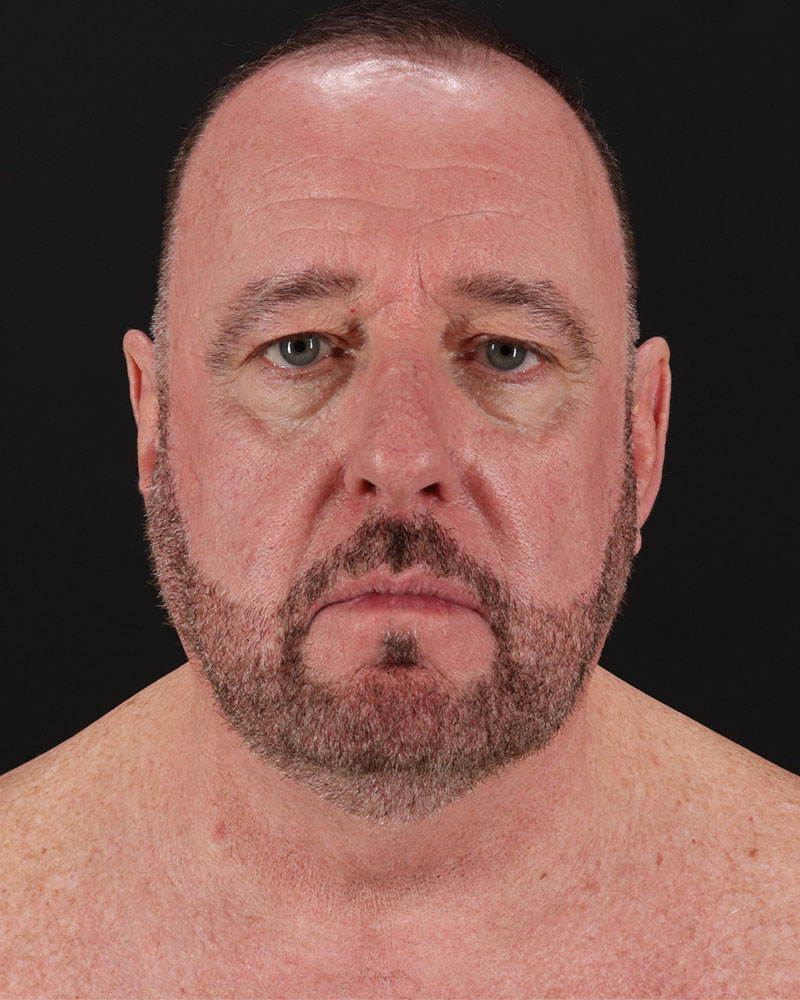 Facelift Before & After Patient #8955