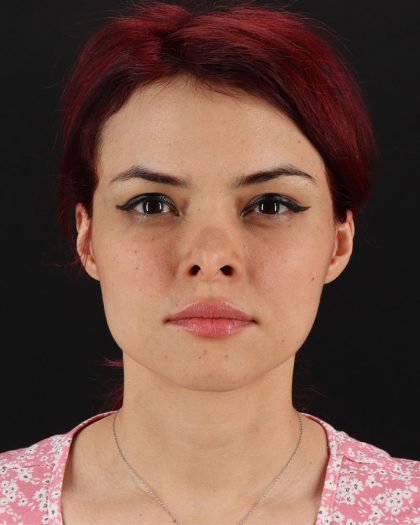 Mini Facelift Before & After Patient #8956