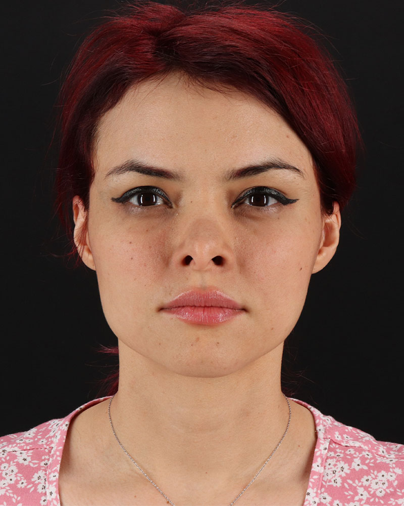 Mini Facelift Before & After Patient #8956
