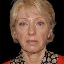 Facelift Before & After Patient #8958