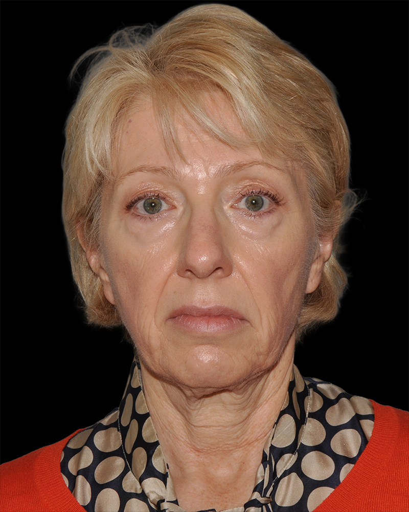 Facelift Before & After Patient #8958