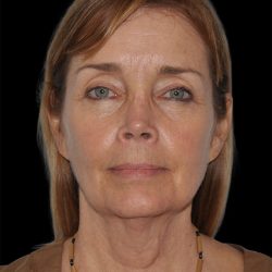 Facelift Before & After Patient #8959